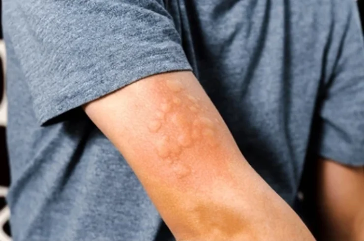 Homeopathy for Allergic Conditions