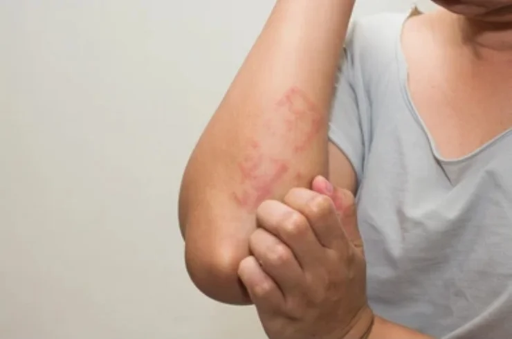 Homeopathy for Skin Conditions